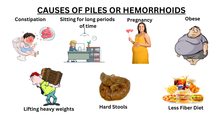 causes of piles or hemorrhoids